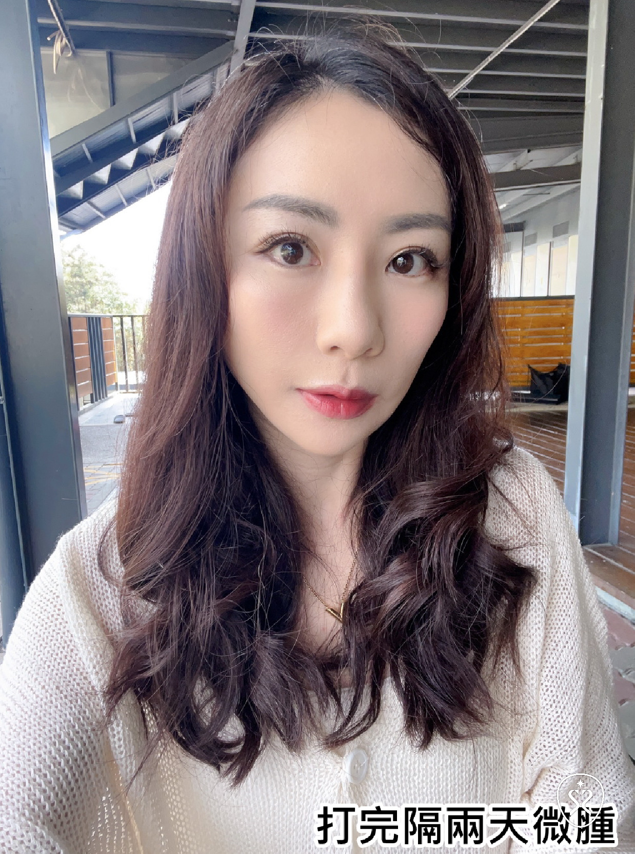 【玻尿酸】星采皮膚專科診所(古亭)-不再焦慮！輕鬆獲得一個順眼的自己 -小雯媽咪愛漂亮